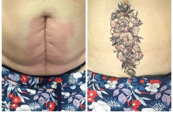 hình xăm che vết sẹo rạch trên bụng